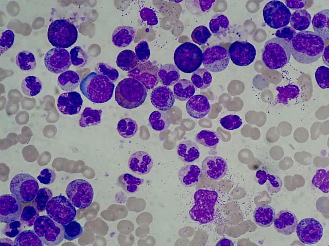 Chronic_Myeloid_Leukemia_smear_2009-04-09